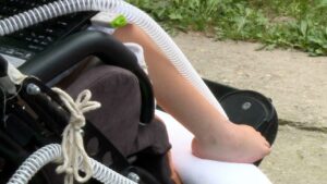 spinalna-misicna-atrofija-323605